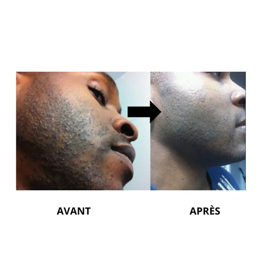 Bump Stopper - Traitement Anti-Bouton de Rasage 2